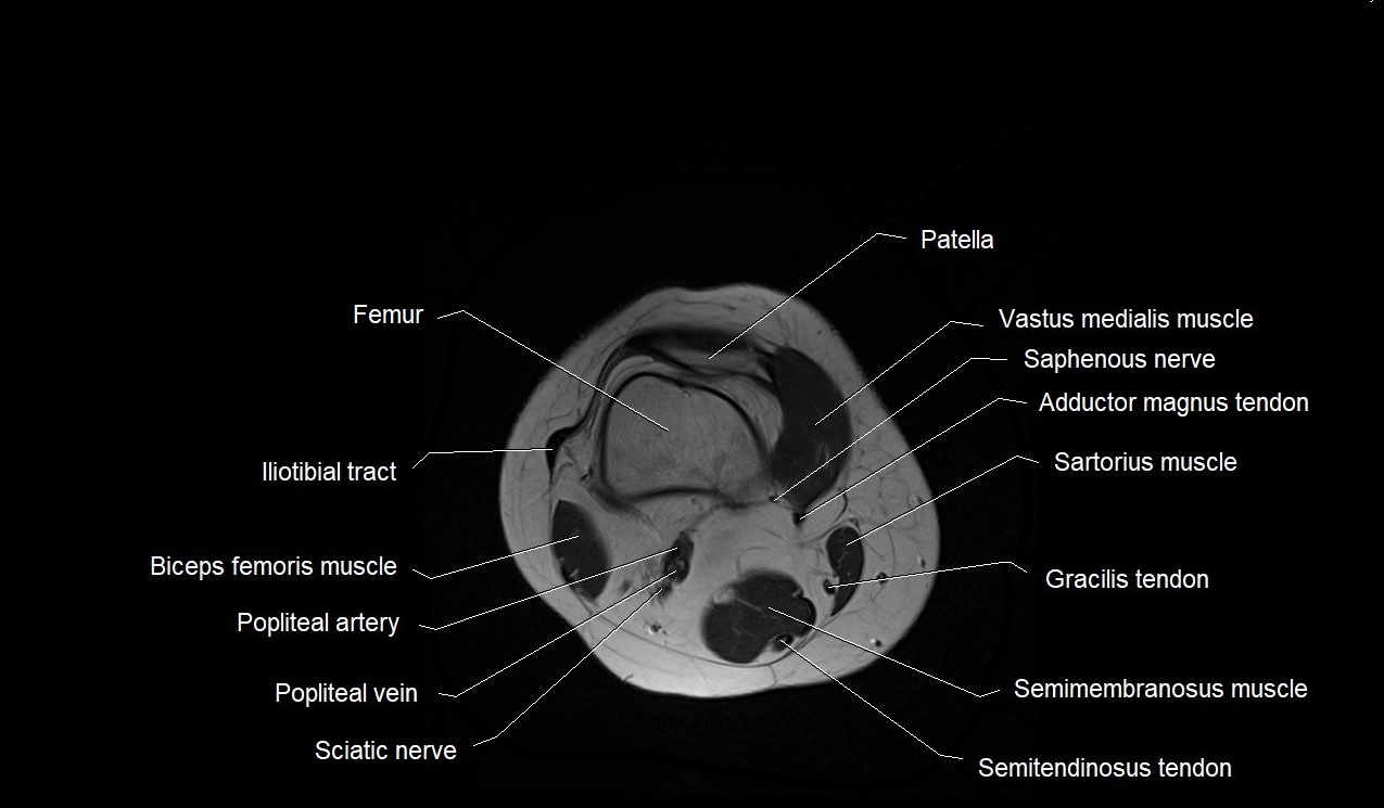 MRI thigh cross sectional anatomy image 52.webp
